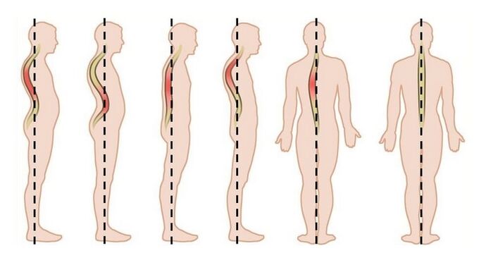 troubles de la posture comme cause d'ostéochondrose thoracique