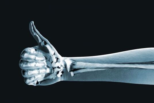 La radiographie peut aider à diagnostiquer la douleur dans les articulations des doigts