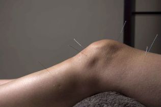 L'acupuncture favorise la réparation des tissus articulaires