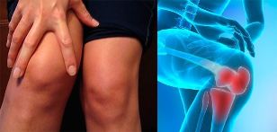 L'inconfort et le gonflement de la région du genou sont les premiers symptômes de l'arthrose