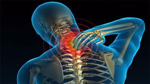 causes de l'ostéochondrose du cou
